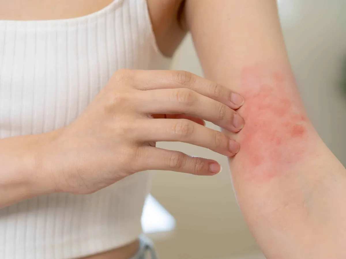 Una mujer que muestra un brote de eccema en el brazo.
