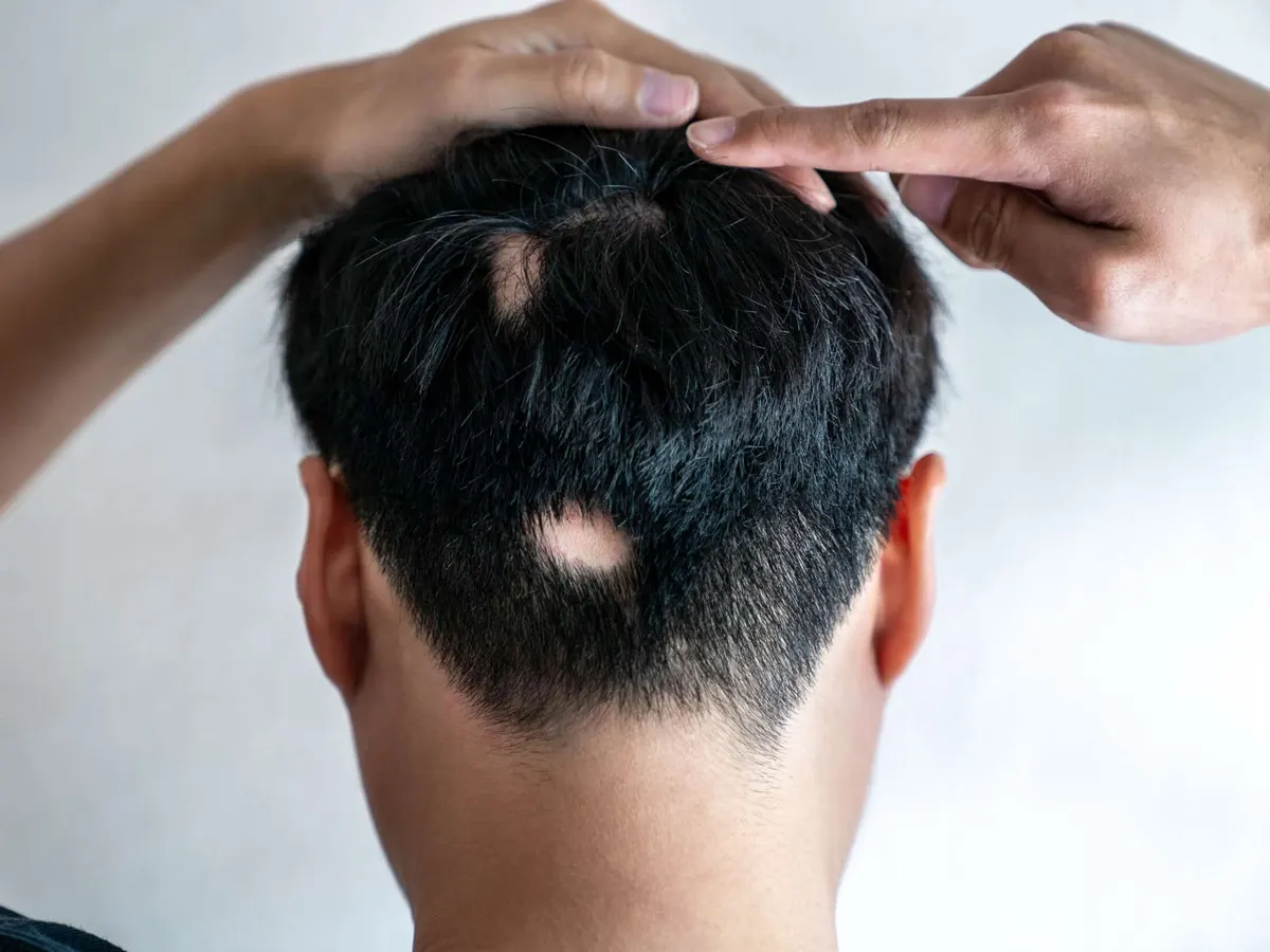 Man with alopecia areata in Hollywood, FL