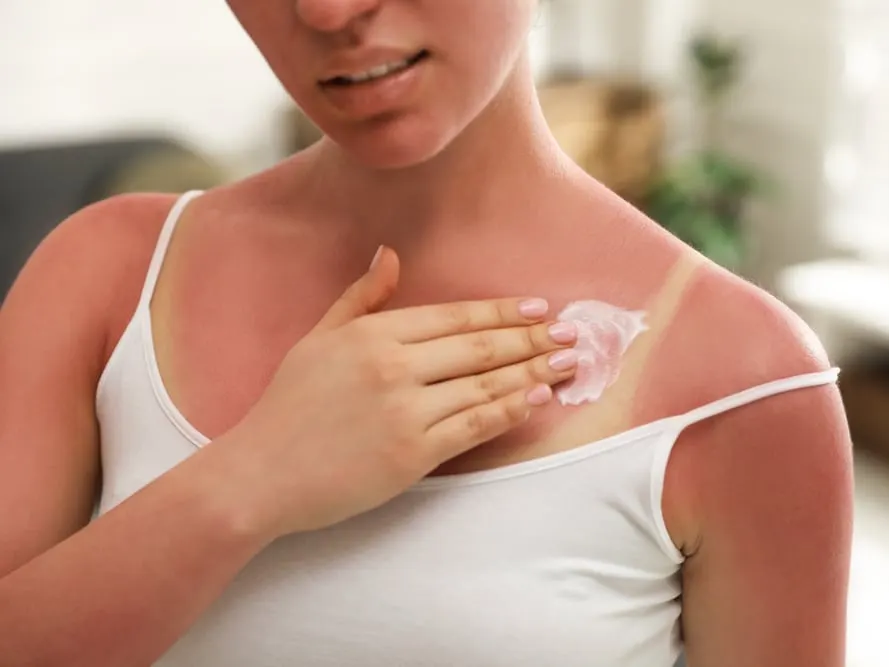 Sunburned woman applying sunscreen to chest