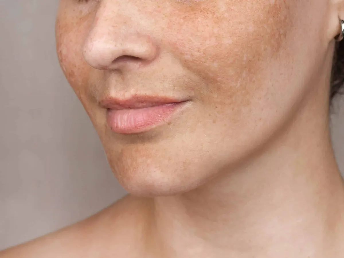 Close up of woman's face showing melasma hyperpigmentation