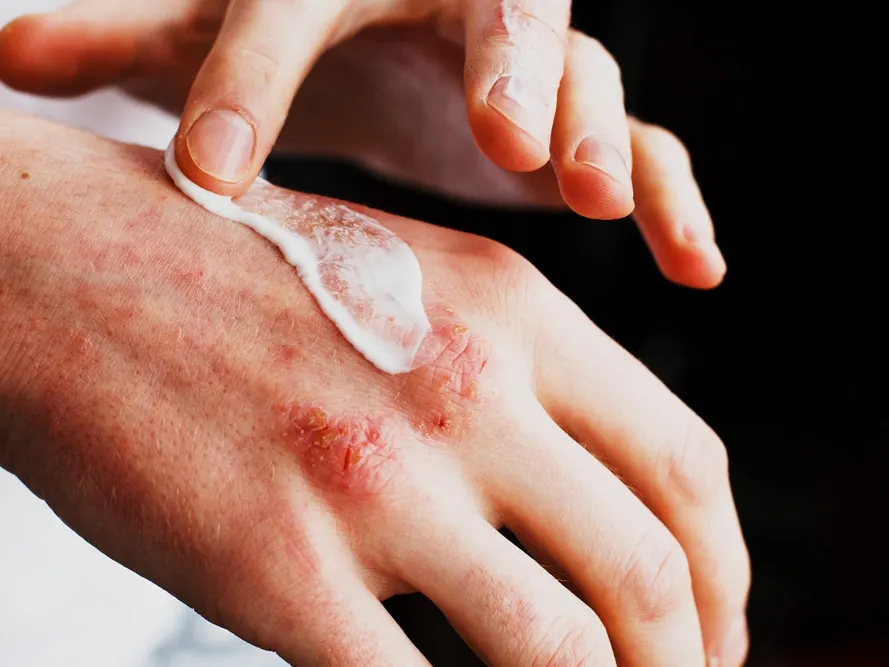 Persona aplicando crema sobre las manchas rojas e irritadas en el dorso de la mano causadas por psoriasis.
