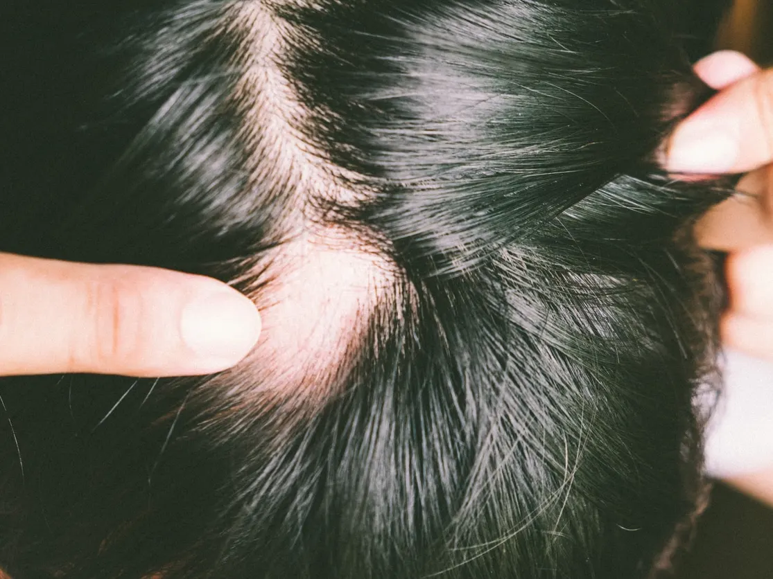Bald spot showing on person with long hair due to alopecia
