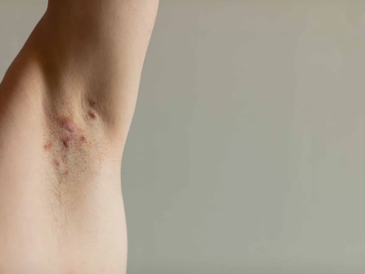 Photo of a man’s armpit with hidradenitis suppurativa breakout