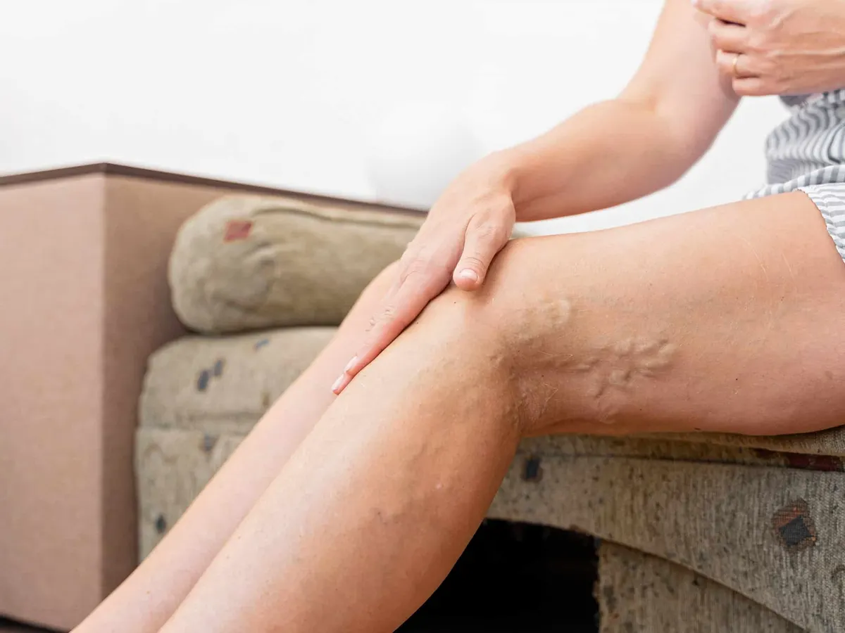 Piernas de mujer con venas varicosas abultadas