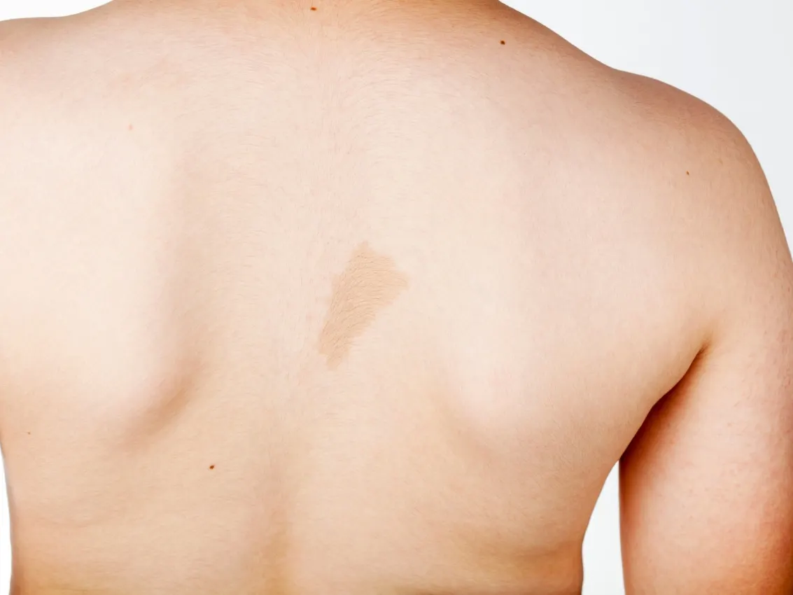 Light brown birthmark on a person’s upper back.