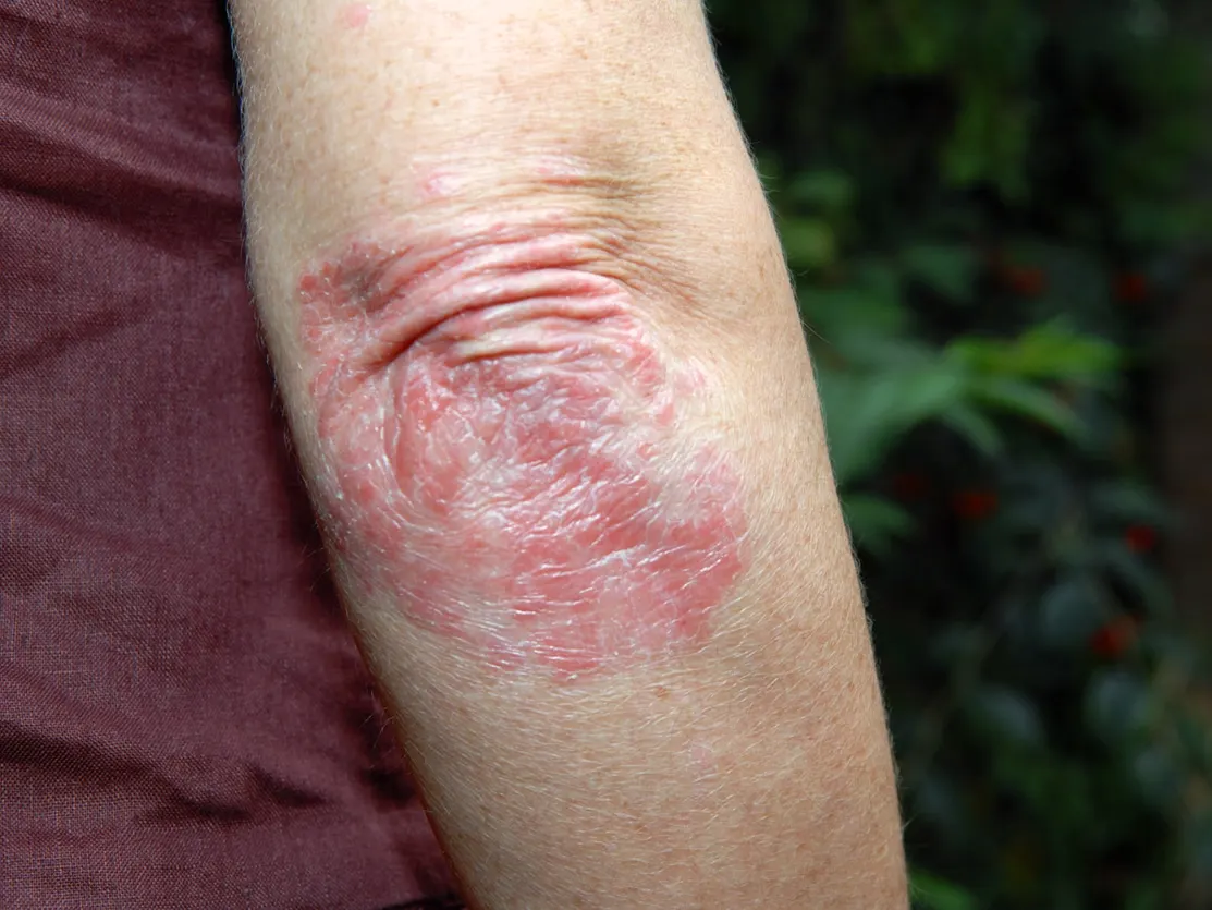 Close-up of red, scaly psoriasis plaques on an elbow.