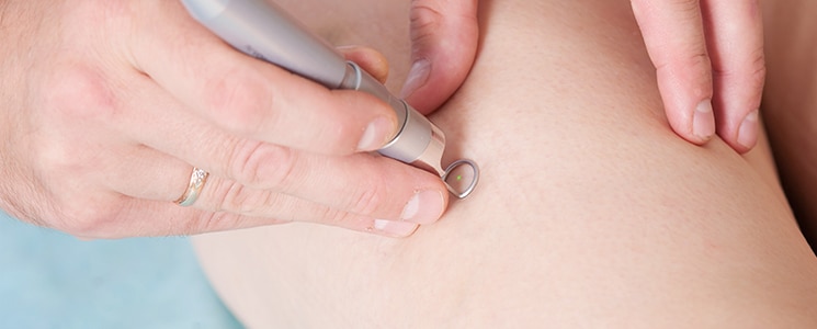 A clinician's hand holds a small laser pen against the skin of a woman's leg