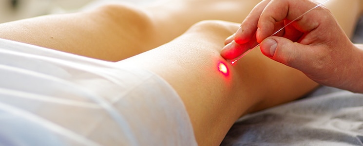 A clinician's hand holds a thin laser fiber with a red light spot against a model's lower leg
