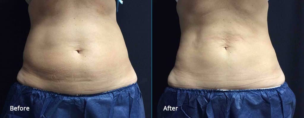 cool sculpting before and after results