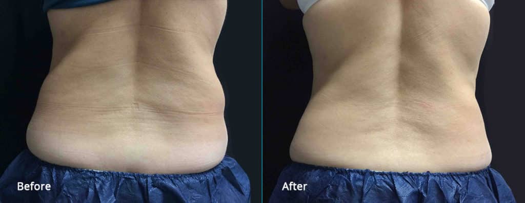 cool sculpting before and after results