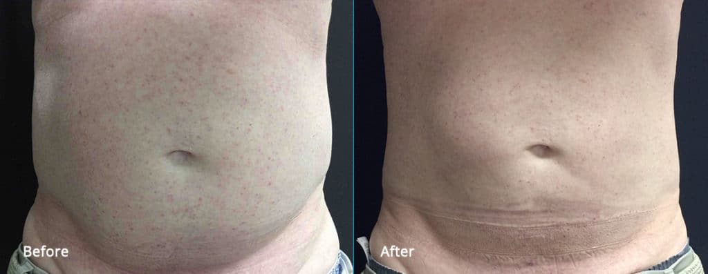 cool sculpting before and after results