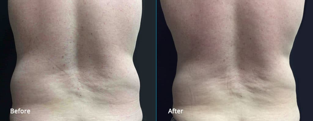 cool sculpting before and after results