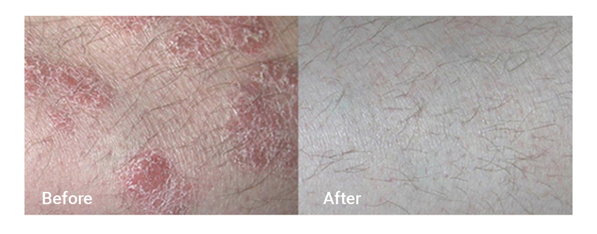Before & After image of Psoriasis Pembroke Pines FL