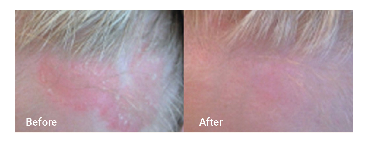 Before & After image of XTRAC laser treatment Broward County FL