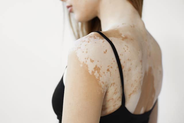 A woman seen from behind in a black top, with light patches of skin across her shoulder and back.