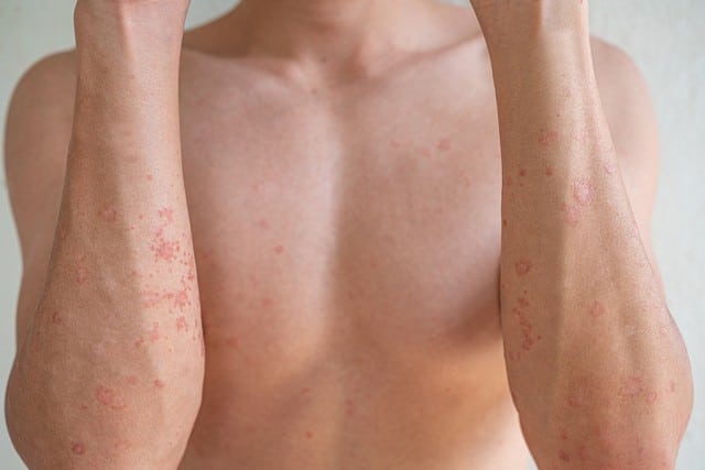 A person's bare chest and forearms with scattered red spots on the skin.