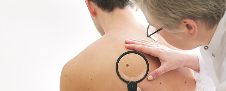 A dermatologist examines a mole on a model’s back through a magnifying glass