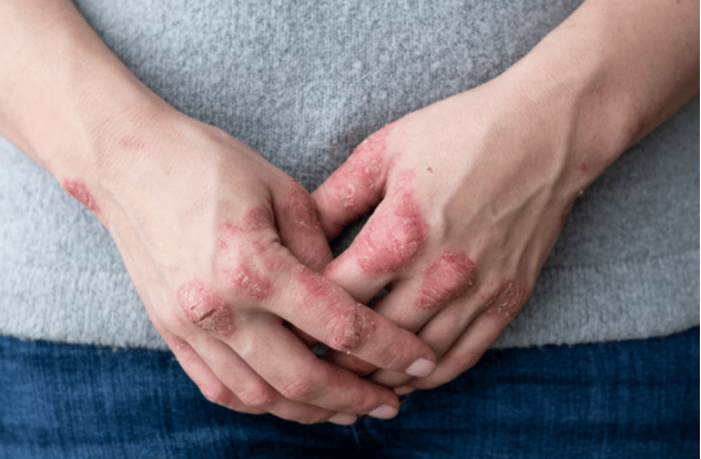 Hands clasped together with red, scaly patches on the knuckles and fingers.