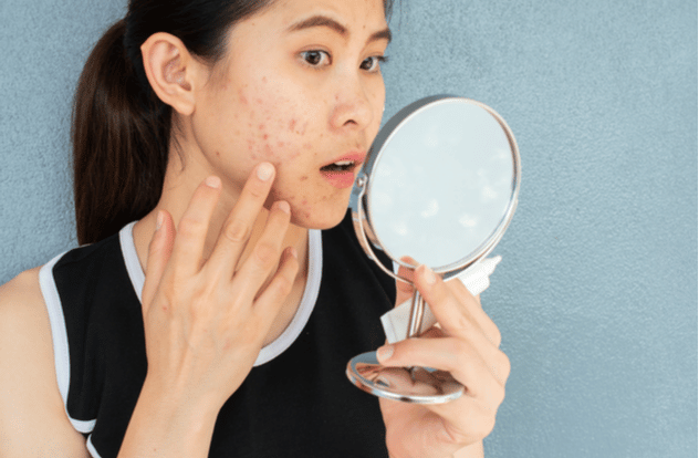 A woman with acne on her cheek touches her face while holding a hand mirror.