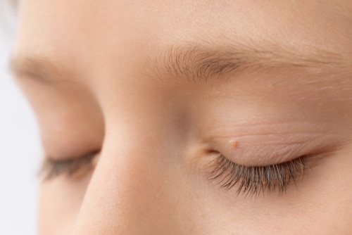 Close-up of a child's closed eyes with a small raised bump on the eyelid.
