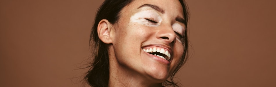 A smiling woman with eyes closed and light patches of skin around her eyes, against a brown background