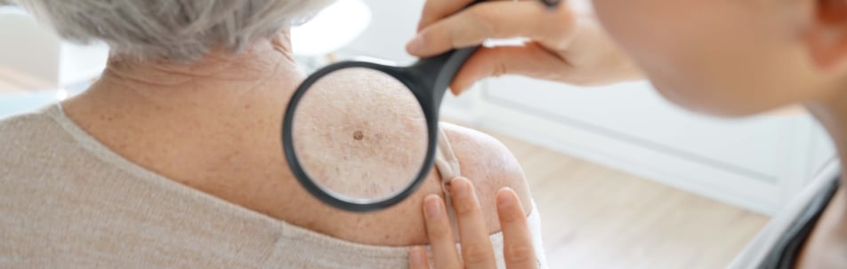 A clinician holding a magnifying glass over a mole on an older woman's shoulder