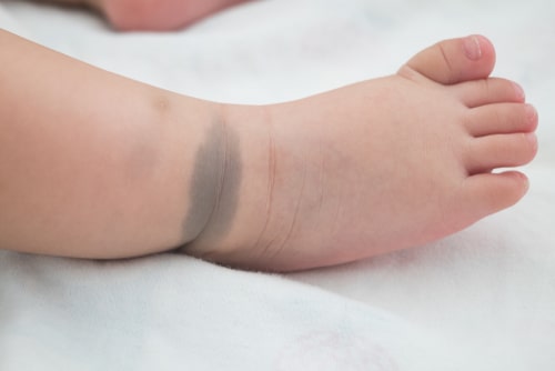 A baby's foot and ankle with a gray-blue birthmark on the ankle.