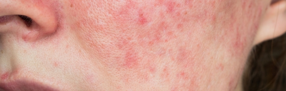 Close-up of red, blotchy patches of skin on a woman's cheek