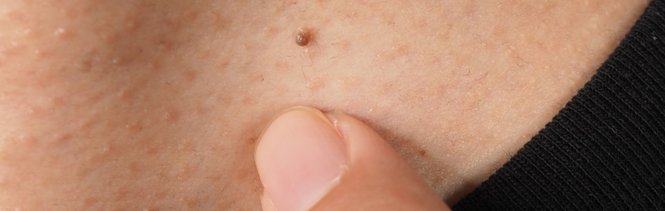 Close-up of a small raised brown mole on skin, with a thumb below it