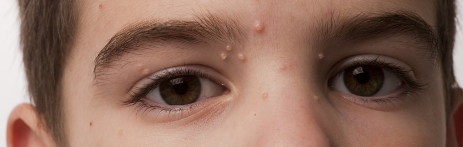 Close-up of a boy's eyes and forehead with several small, round, pearly bumps on the skin