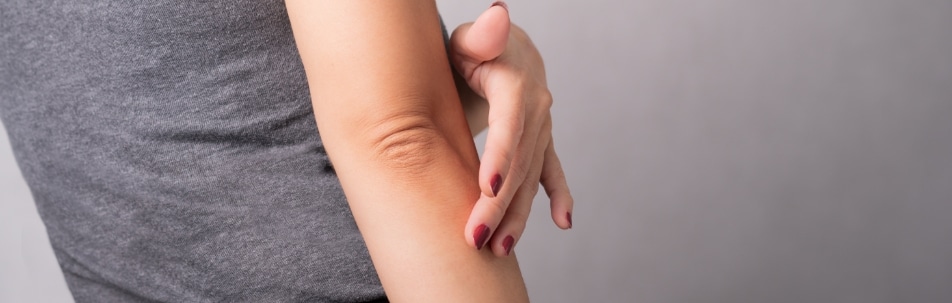 A woman holding her fingers to her elbow, which shows a patch of redness