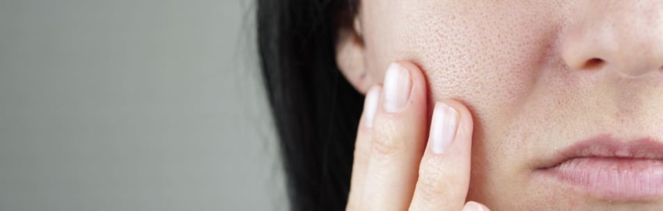 Close-up of a woman's cheek with visible enlarged pores as she touches her face