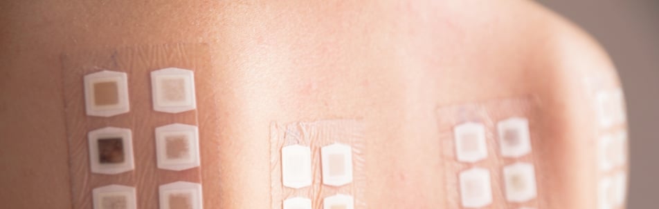 Rows of small adhesive patch-test panels applied to a person's back