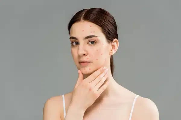 A young woman with small red bumps on her face rests a hand under her chin against a gray background.