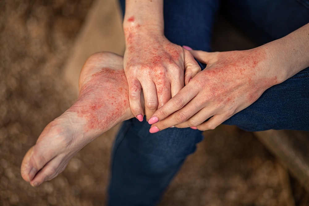 A woman holds her foot, with red, irritated skin visible on her hands and foot.