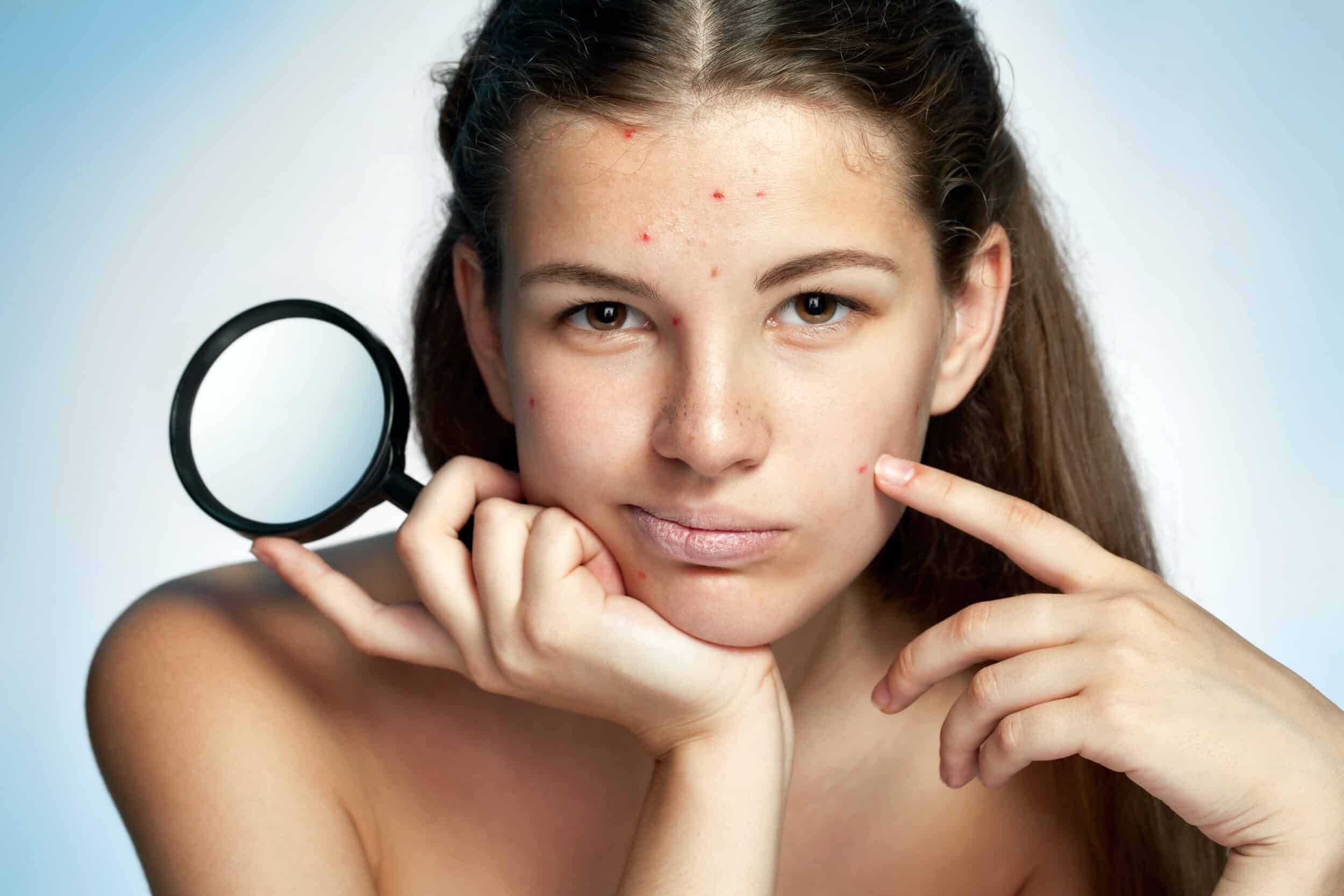 A teen girl with acne on her face frowning and holding a magnifying glass