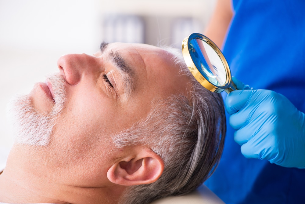 Doctor examining older man's scalp area for skin cancer