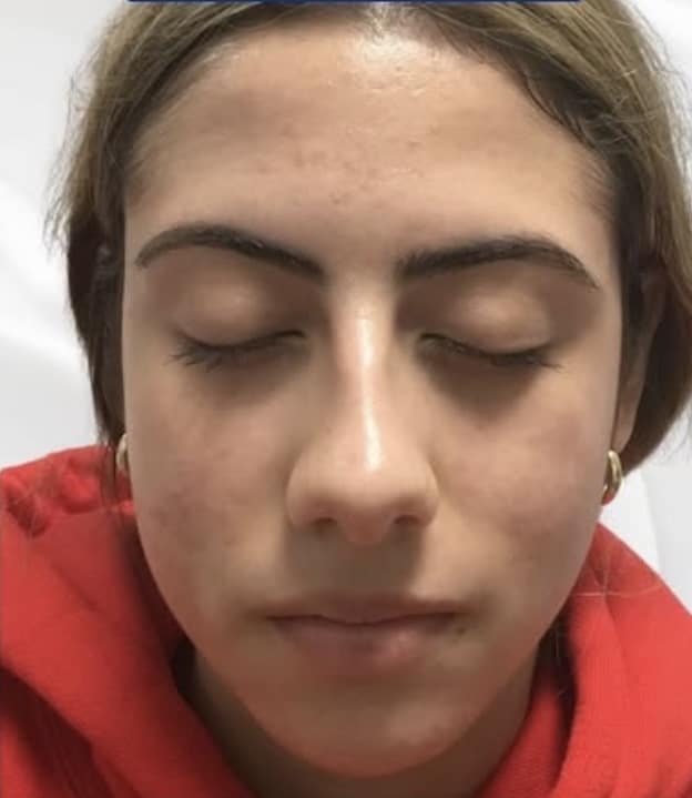 After Image: Acne on Face - front