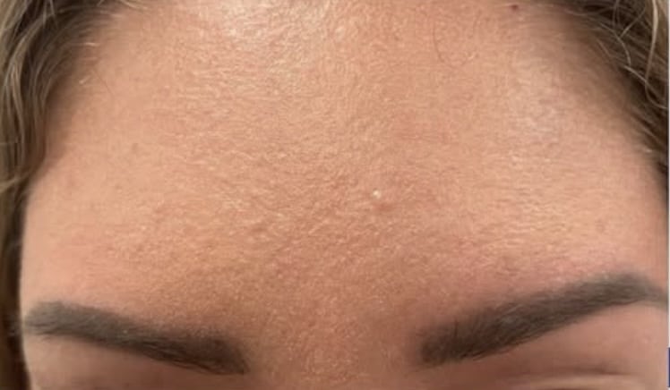 After Image: Botox Cosmetics Crows Feet - left-front-oblique