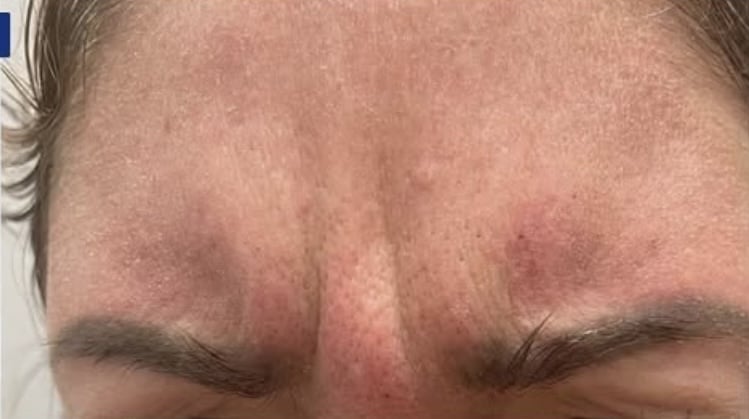 Before Image: Botox Cosmetics Crows Feet - left-front-oblique