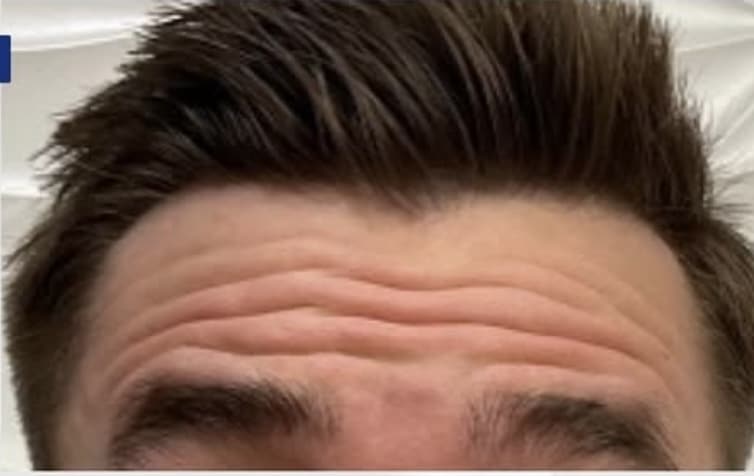 Before Image: Botox Cosmeticson Forehead - front