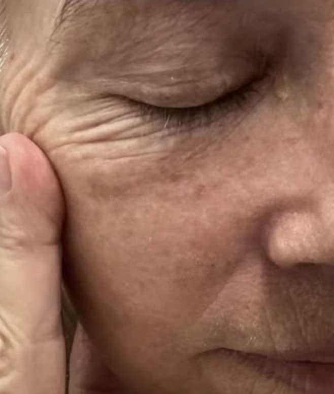 After Image: Seborrheic Keratosis - right-front-oblique