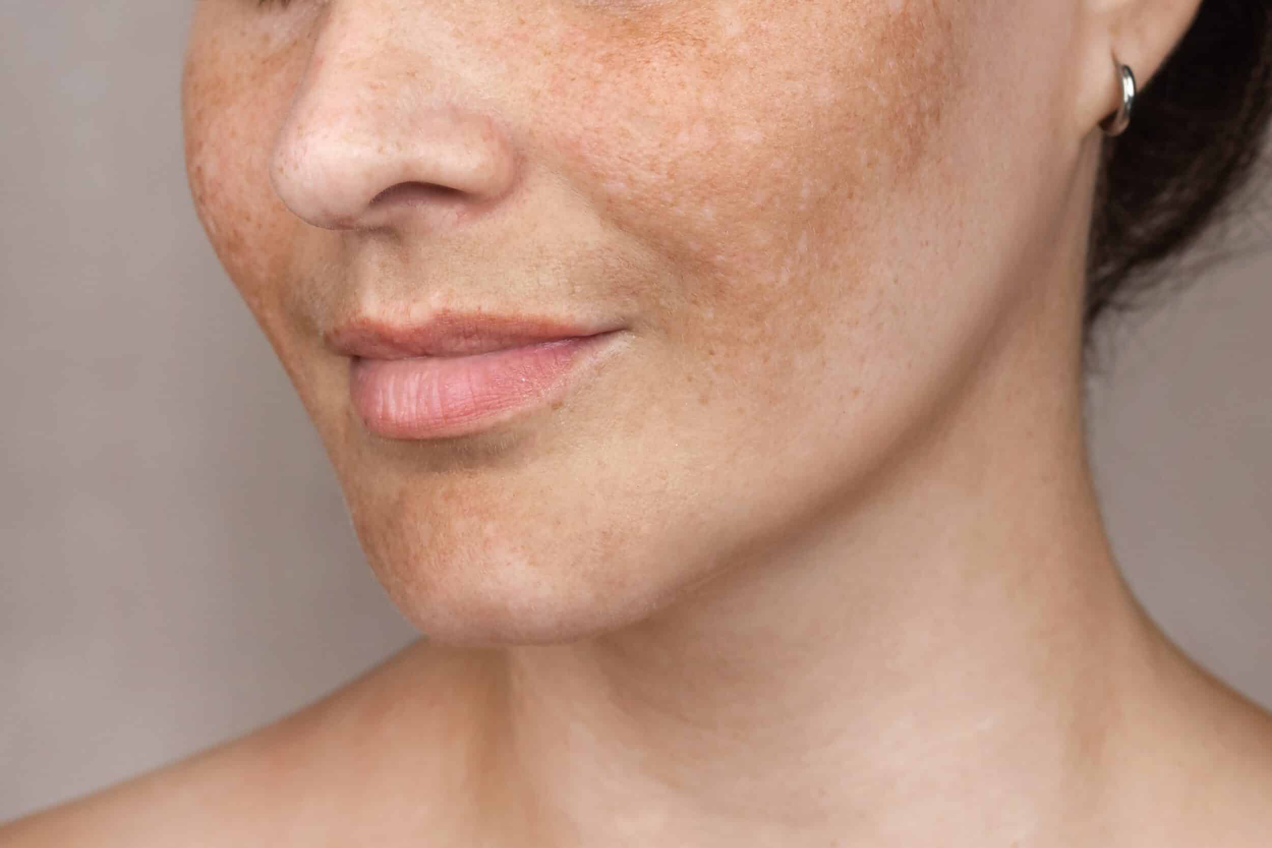 Close up of woman's face showing melasma hyperpigmentation