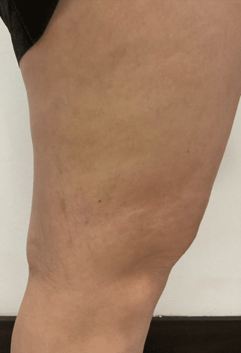 After Image: Sclerotherapy - right-side