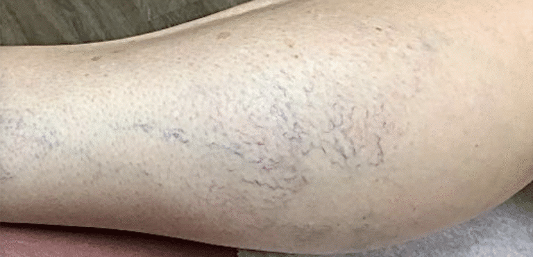 Before Image: Sclerotherapy - left-side