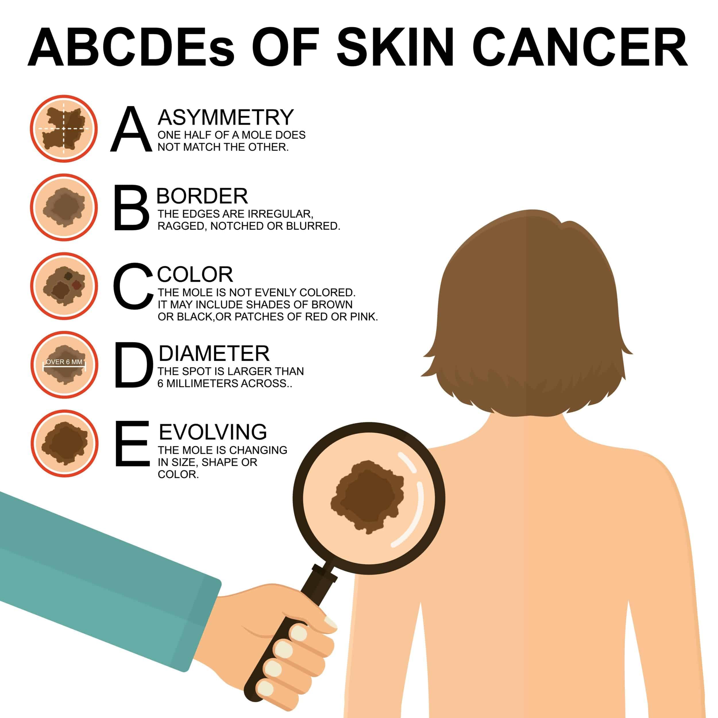 Graphic chart showing the ABCDE Guide for spotting melanoma in Broward County, FL