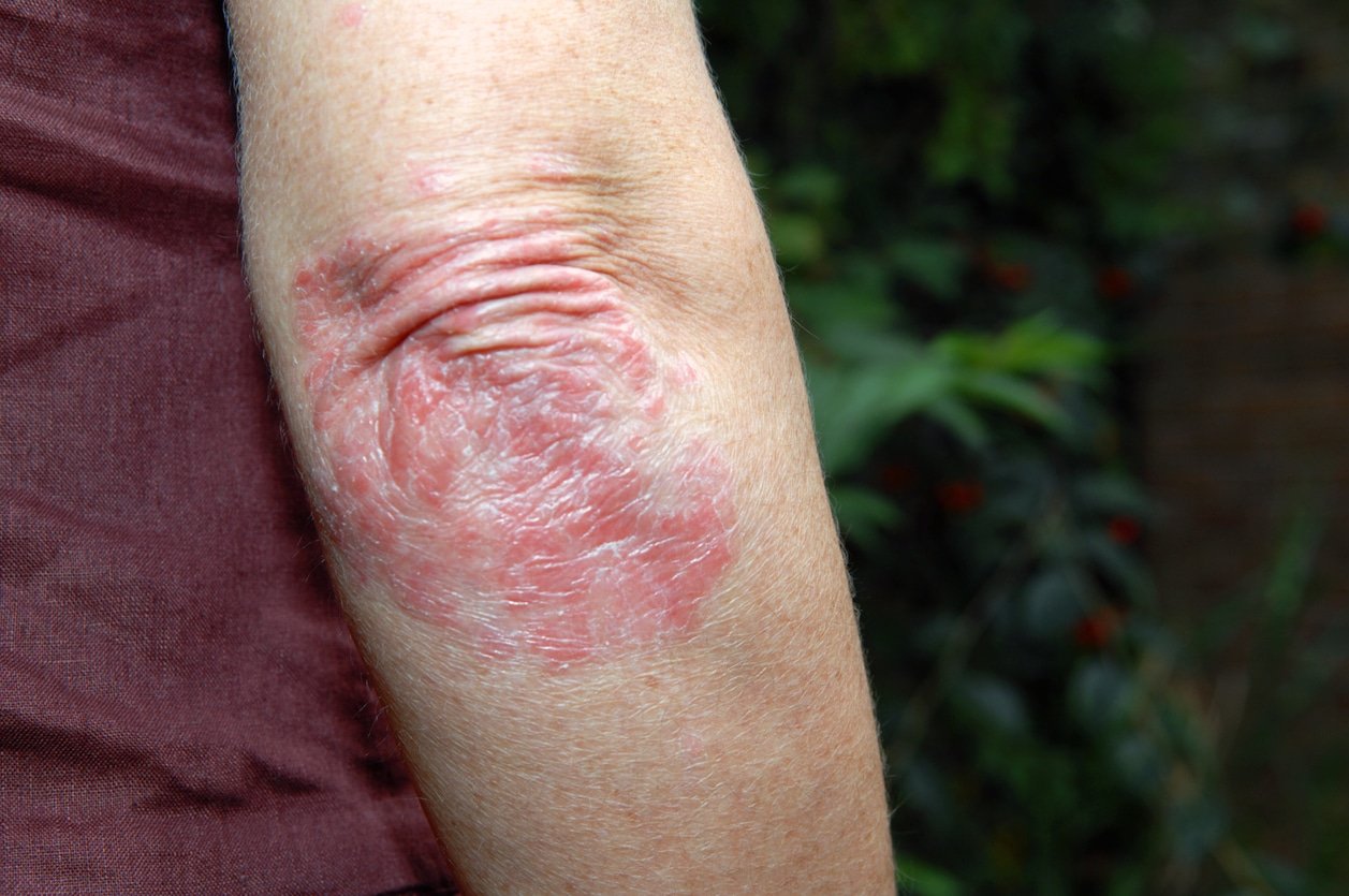 Close-up of red, scaly psoriasis plaques on an elbow.