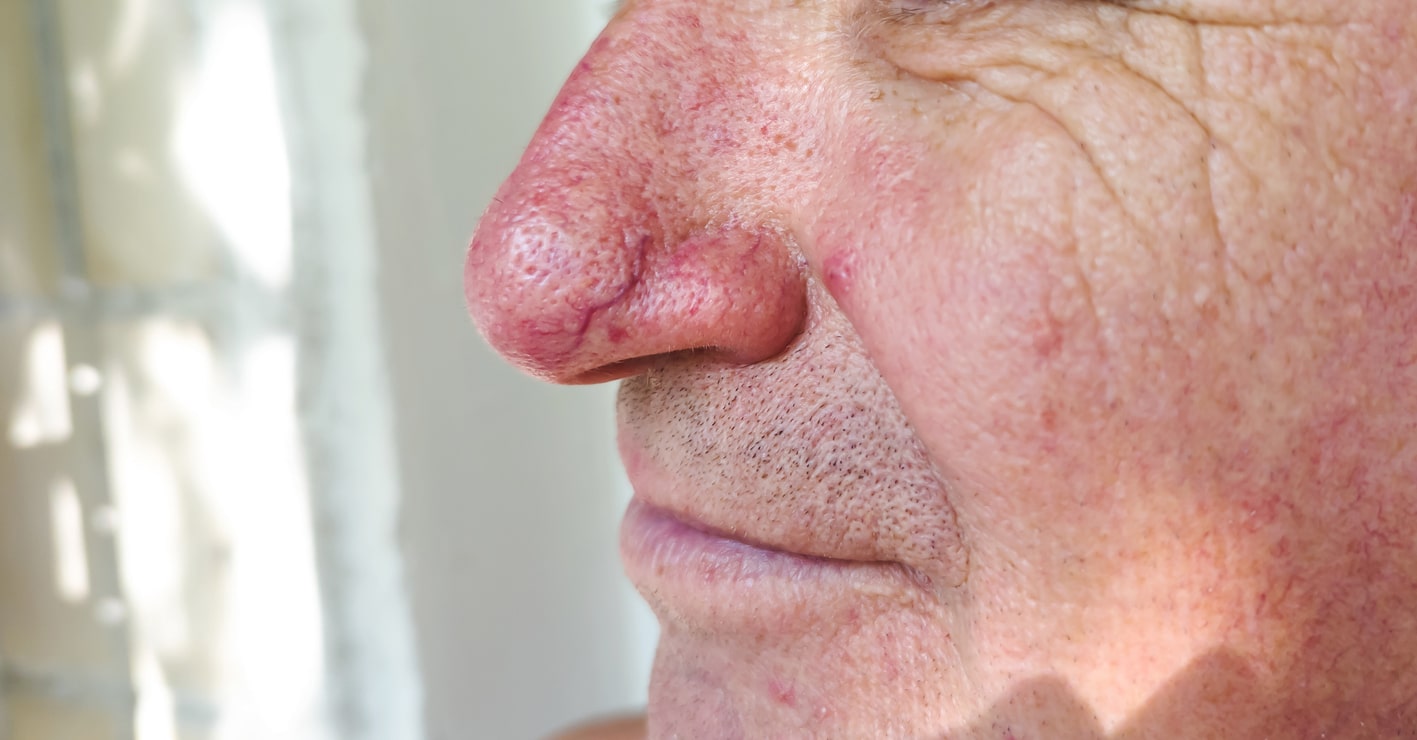 Close-up of an older adult with redness, thickened skin, and enlarged pores on the nose consistent with rhinophyma.