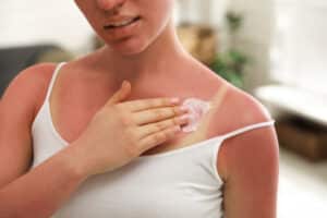 Sunburned woman applying sunscreen to chest