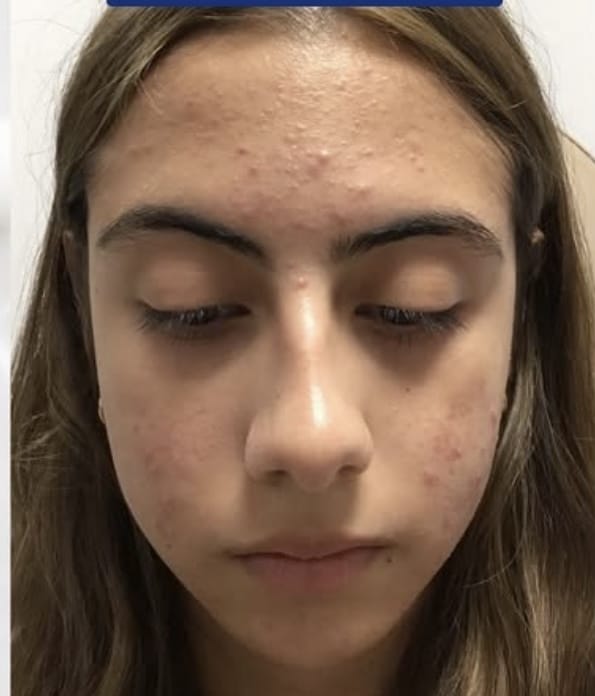 Before Image: Acne on Face - front